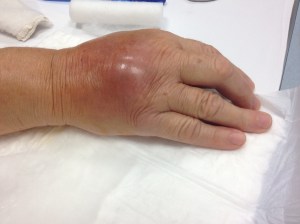 Cellulite conseguente a morso di gatto (A. Bedini, 2014)